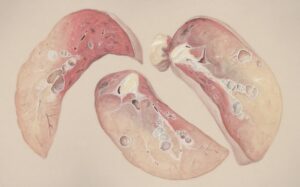 Asthma Medications Inhalers, Steroids, and Beyond